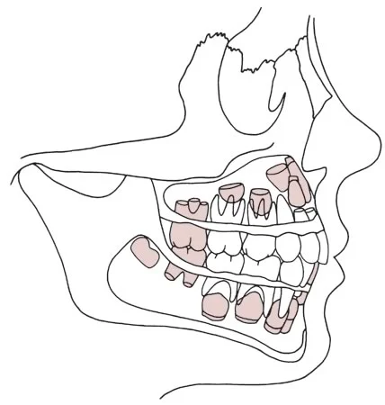 Dental age 6: First molars and mandibular incisors erupting