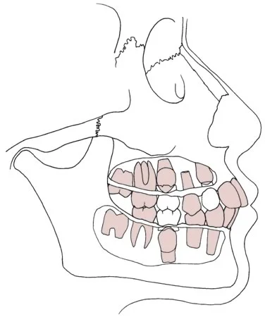 Dental age 11: Maxillary and mandibular first premolars erupt as well as the mandibular canine.