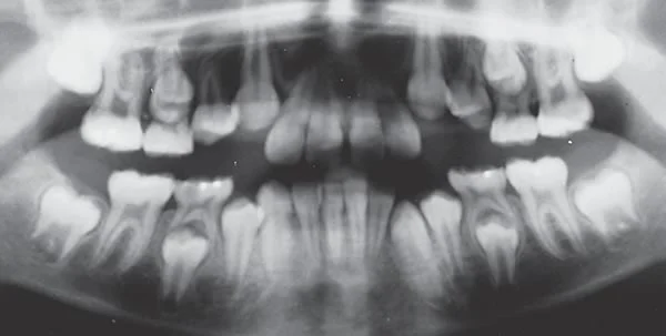Dental age 11: Can you identify the key indicators of dental age 11 in this image?