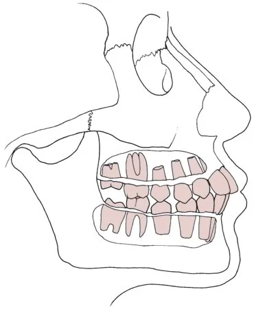 Dental age 12: The remaining succedaneous teeth erupt at dental age 12 as well as the permanent second molars.