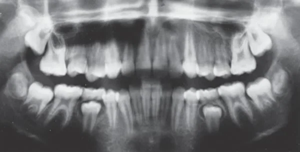 Dental age 12: Can you identify the hallmarks of dental age 12 in this image? Note the developing third molars in all quadrants.