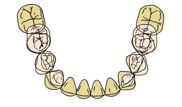 Mandibular arch width changes: The mandibular arch increases in width ~2mm across the canines.