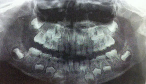 Dental age 6: A panoramic radiograph shows root development of the permanent teeth and resorption of the primary teeth. Can you identify the hallmarks of dental age 6 in this image?