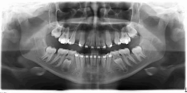 Mandibular second molars ahead of second premolars: This patient’s mandibular second molars are erupting well-ahead of her second premolars.