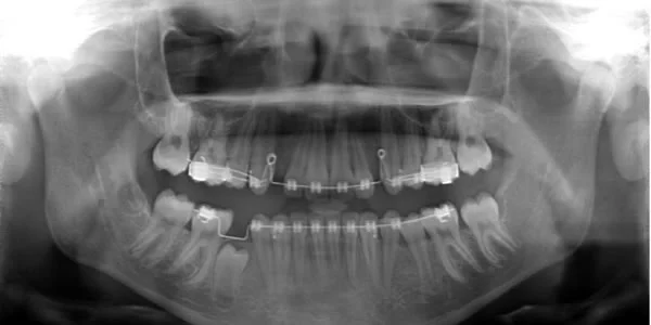 Mandibular second molars ahead of second premolars: Space was opened for this girl’s mandibular second premolars using a fixed appliance, and one has already erupted.
