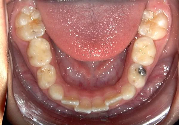Occlusal view of developing mandibular dentition: The lateral incisors are lingual – mirroring the position of the tooth bud from which they came.