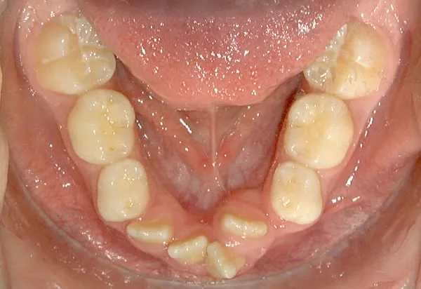 Occlusal view of developing dentition: With crowding, the lingual position of the laterals is accentuated.