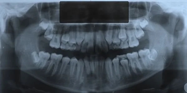 Radiograph showing simultaneous eruption of maxillary canines and first premolars: Eruption of the maxillary canine at the same time as the first premolar can result in a labially displaced and unsightly canine.