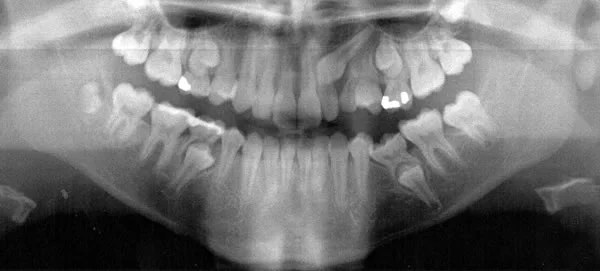 Radiograph showing impaction of the upper left canine: Extracting the maxillary primary canine may have prevented impaction of the permanent tooth.