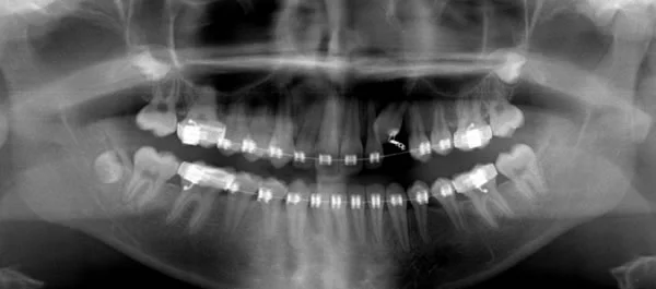Radiograph showing treatment of the previous patient: The primary second molars have been extracted to allow the second premolars to erupt. The impacted maxillary canine is being brought into to the arch with a fixed orthodontic appliance.