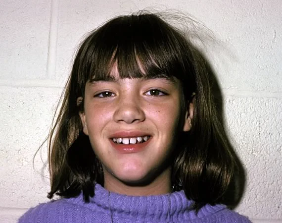 The “ugly duckling stage”: The space between the maxillary central incisors can be a problem that warrants intervention for some patients.