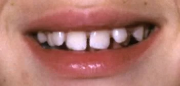 The “ugly duckling stage”: The space between the maxillary central incisors can be a problem that warrants intervention for some patients.