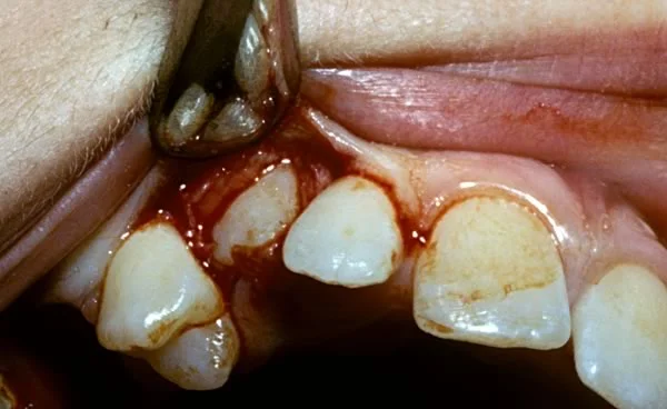 Exposure of permanent canine: The permanent canine is exposed to ensure that it will be able to erupt.