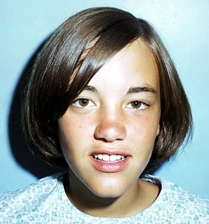 Resolution of the diastema: Eruption of the permanent canines alone has improved her appearance significantly.