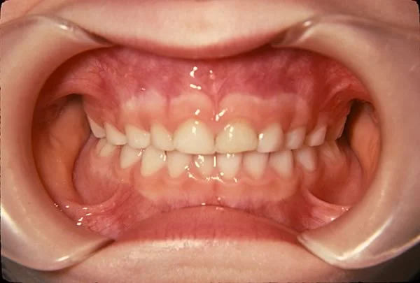 Primary dentition with no spacing: The absence of spacing in the primary dentition is a good indicator of future crowding.