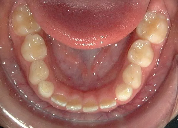 Aligned mandibular incisors: The incisor liability has been overcome using the primate space.