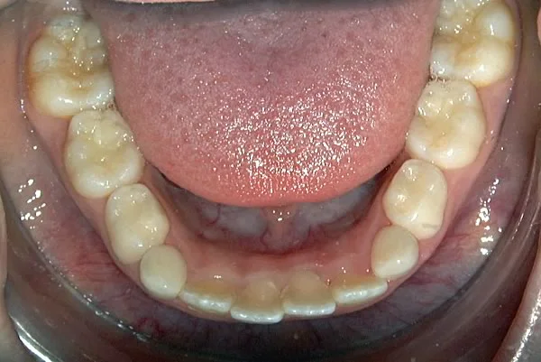 Space used as the mandibular laterals erupt: Often the eruption of the mandibular lateral incisors results in crowding.
