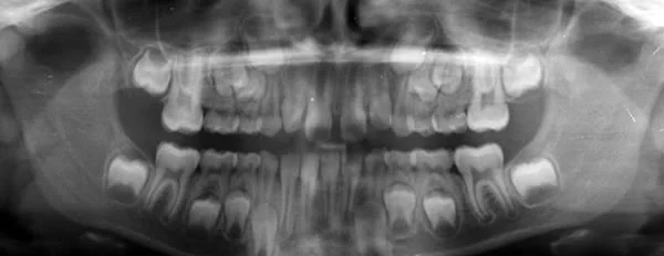 Dental age 7: Can you identify the key indicators of dental age 7 in this image?
