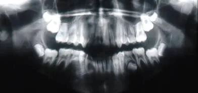 Note the missing mandibular right 2nd premolar and very delayed formation of the left 2nd premolar.