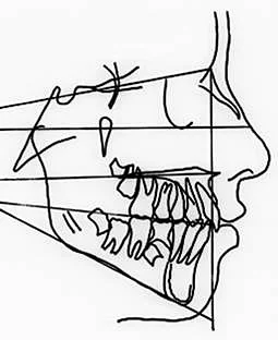 Anna, age 12, cephalometric tracing with reference lines.