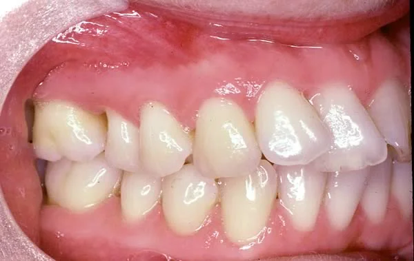 Crowded teeth: Crowded teeth: is extraction necessary?