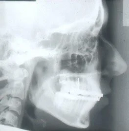 Cephalometric radiograph, treatment nearly completed.