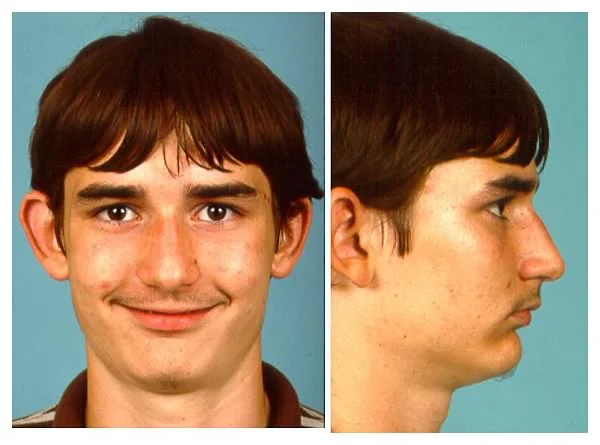 Adam, age 18. Mandibular deficiency is apparent in the profile view.