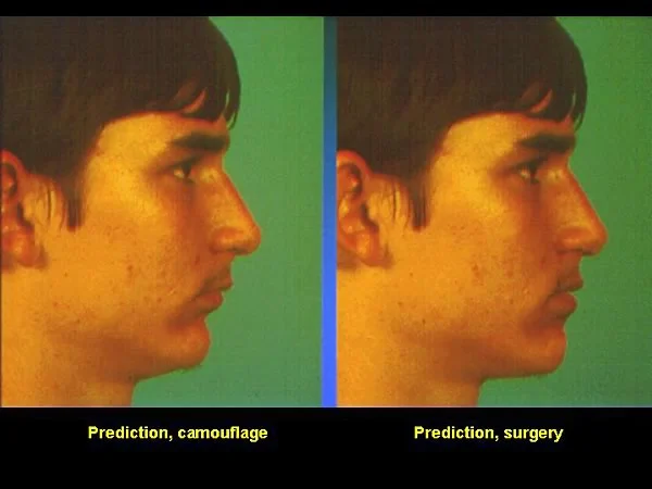 Predictions, camouflage versus surgery.