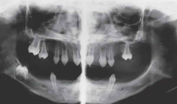 Panoramic radiograph of congenitally missing teeth (severe hypodontia). All those missing teeth never formed.