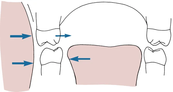 Forces affecting the arch shape: Thumbsucking effectively increases the inward force from the cheeks and decreases the opposing force from the tongue. These changes lead to a v-shaped upper arch.