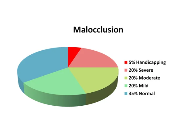 Percentages of the US population with each level of malocclusion severity.