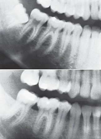 Radiographs of the same individual 10 years apart: The pulp chambers have decreased in size significantly with age.