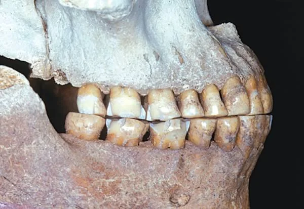 An adult aboriginal skull: Note both the occlusal and interproximal attrition.