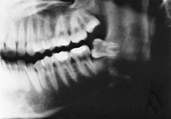 Horizontally impacted lower 3rd molar: It is easy to see how one might think a third molar like this one would push the other teeth forward and create lower incisor crowding.