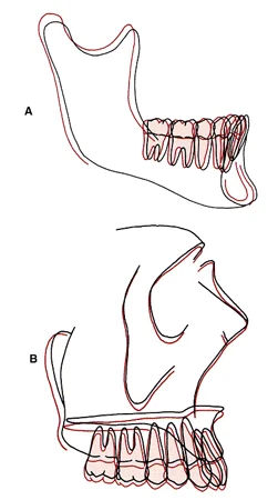 Average regional superimpositionsfrom Behrent’s study: Dento-alveolar changes in adults follow the same pattern as those of adolescents, but at a very different rate.
