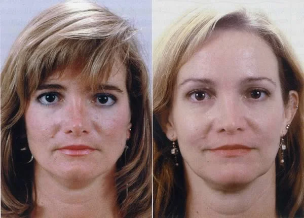 The same woman at age 25 and 40: Can you see the changes in soft tissue described above?