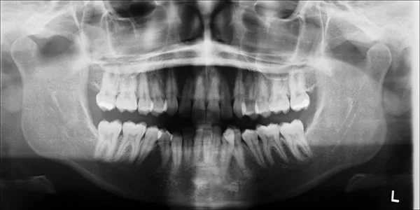 Congenitally missing third molars: Mandibular incisor crowding still developed in this patient during his late teens, even though the third molars were never present.