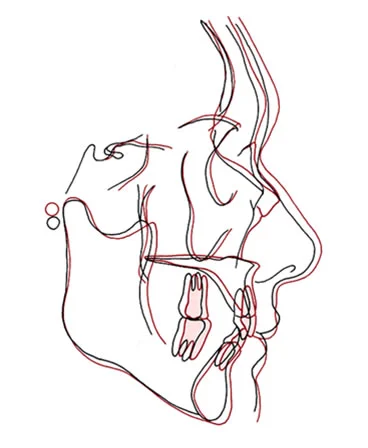 Superimposition of radiographs taken 50 years apart: Surprisingly, growth of the facial hard and soft tissues continues at a very slow rate late into life.