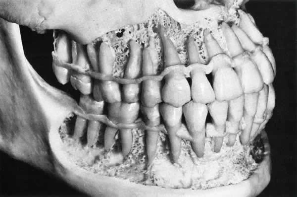 Dissected adult skull showing dentition: Minimal interproximal wear is present, yet the teeth are well-aligned.