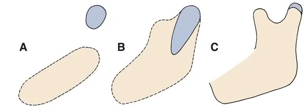 The developing bony and cartilaginous components of the mandible: The cartilage that will eventually cover the head of the mandibular condyle forms separately from the mandible (A) and fuses with the mandibular body around 4 months in utero (B).