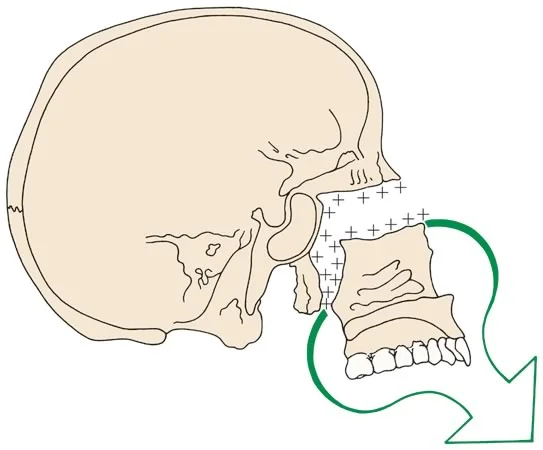 Apposition of bone at the sutures surrounding the maxilla as it grows down and forward.