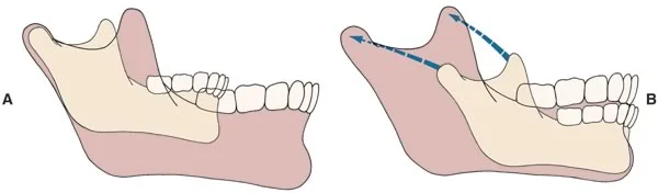 The pattern of mandibular growth from two viewpoints: The mandible appears to grown downward and forward, away from the cranial base (A). In reality, bone is added to the posterior border of the mandible and vertically to the ramus at the condyle (B).
