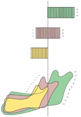 Remodeling resorption of the mandible: Bone is removed (-) from the anterior surface of the ramus and added (+) to the posterior surface.