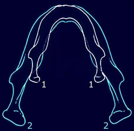 Axial view of remodeling of the mandible: Surface resorption and apposition also allow for the mandible to increase in width.