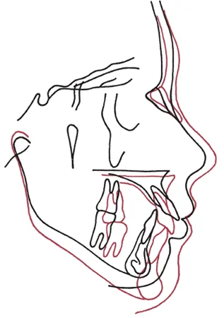 Cephalometric superimposition: Superimposing cephalometric tracings from the same patient over time allows the visualization of craniofacial growth over time.