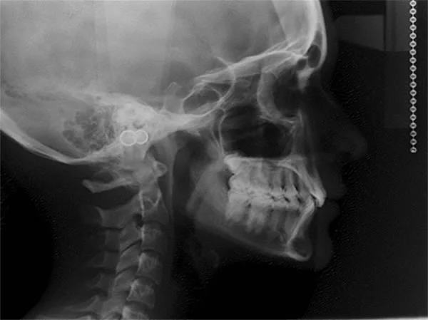 Cephalometric film: This type of radiograph allows for the visualization of the craniofacial hard tissues in the a-p and vertical planes of space.