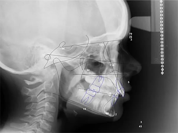 Cephalometric film traced: By tracing key structures on the radiograph, important information is condensed and emphasized.