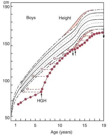 Growth curve for an individual with a growth hormone deficiency: After injections of human growth hormone began (HGH), catch-up growth occurred.