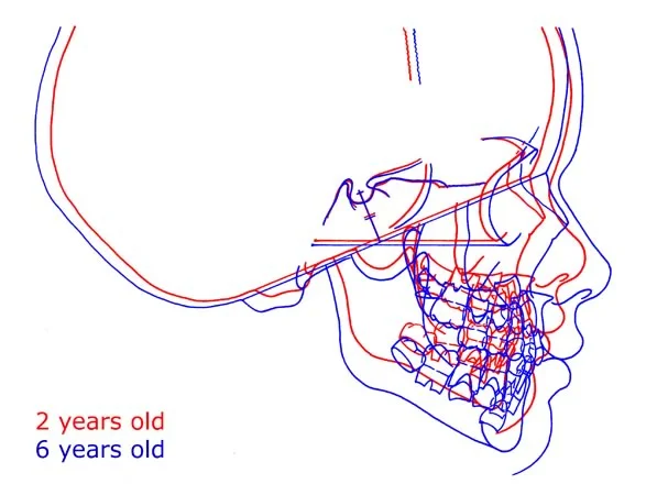 Cephalometric superimposition of a growing child: The cranium has enlarged, and the maxilla and mandible have grown down and forward as expected.