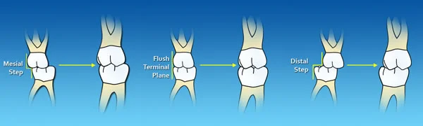 Transition from primary to permanent dentition: Expected occlusal relationships of the permanent molars based on the primary molars.